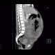 Metastasis of malignant melanoma in peritoneal cavity: CT - Computed tomography